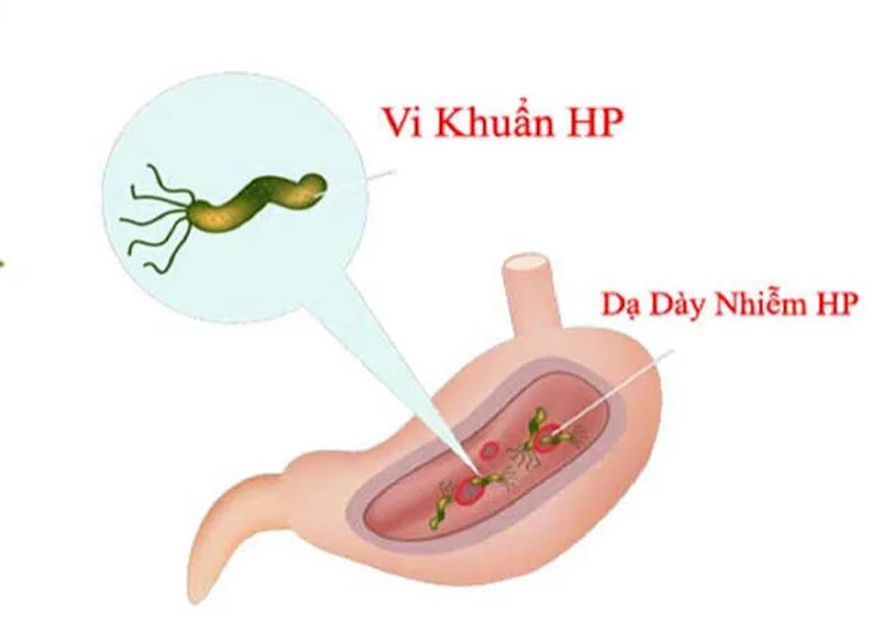 HP dạ dày là gì